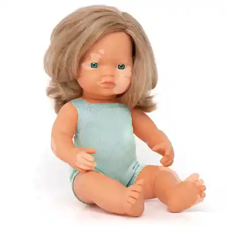 Doll with Vitiligo