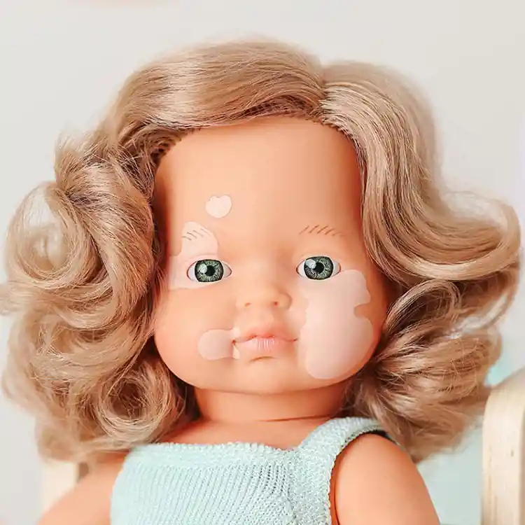 Doll with Vitiligo